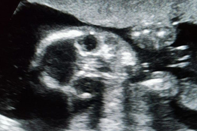 peek a boo ultrasound