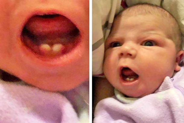 Baby Born With Teeth 610x407 