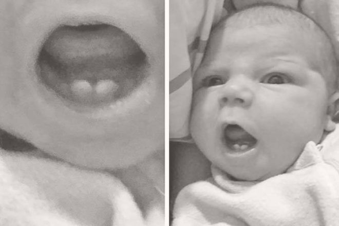 Baby born with teeth