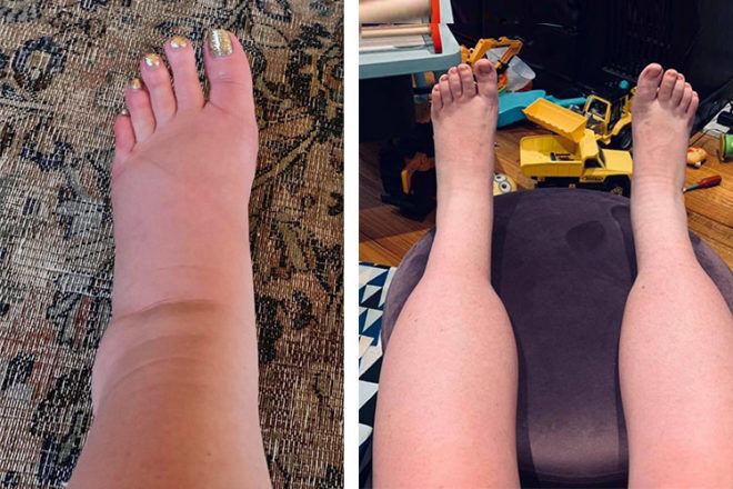 how-to-reduce-feet-swelling-during-pregnancy-stuffjourney