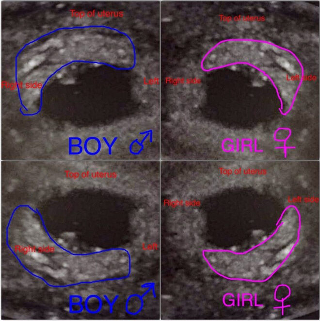 Boy how ultrasound or pictures tell to girl Male vs