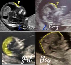 How to 'predict' baby's gender from an early ultrasound | Mum's Grapevine