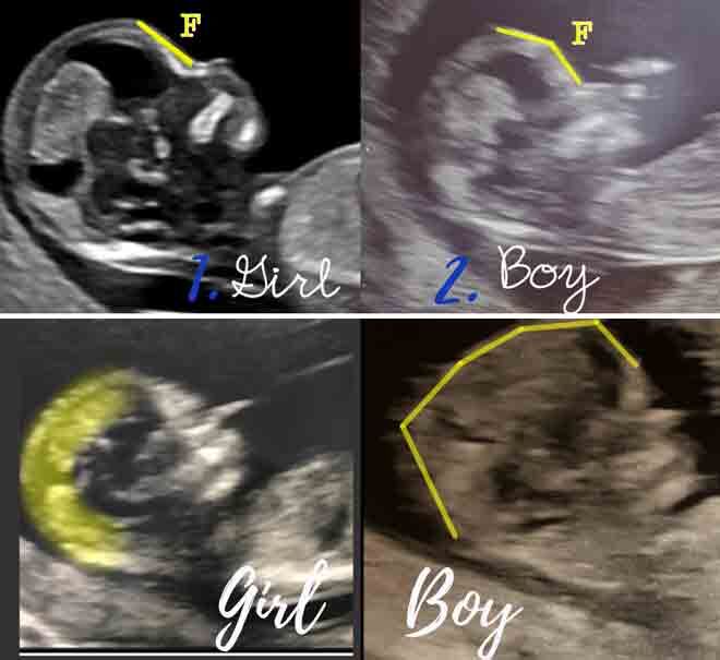 Gender weeks ultrasound 13 at How to
