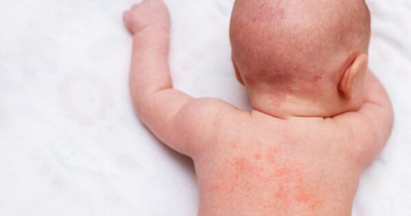 9 Ways To Soothe A Baby With Eczema Mums Grapevine