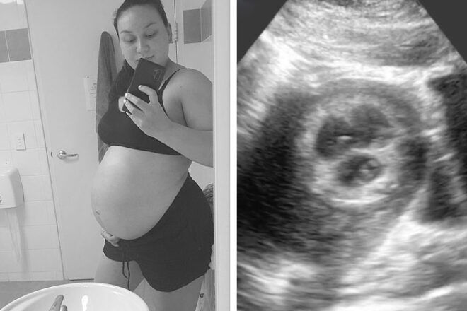 Triplet birth story Nat Turner